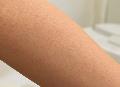 Urea gegen Reibeisenhaut: Diese Alternativen wirken besser